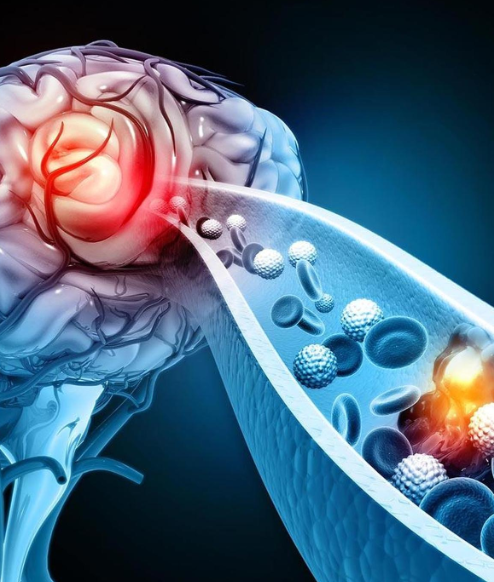 Indigenously built stroke device approved on domestic trial data, launch set for February 2026 